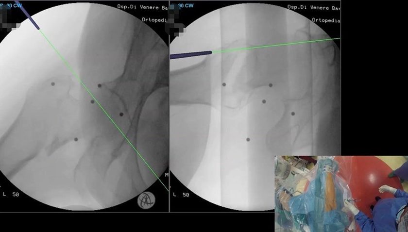 Ortopedia “Di Venere”: nasce il primo sistema per trattare la frattura del femore in realtà virtuale